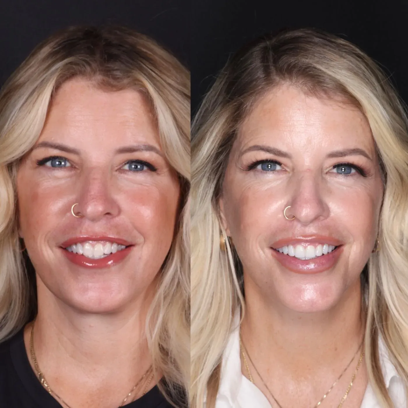Before and after smile transformation by Dr. Kooper