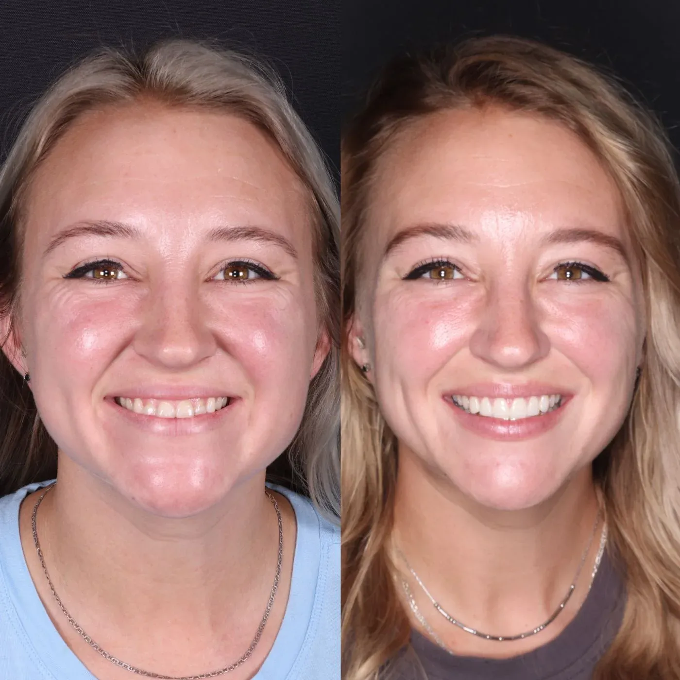 Before and after smile transformation by Dr. Kooper