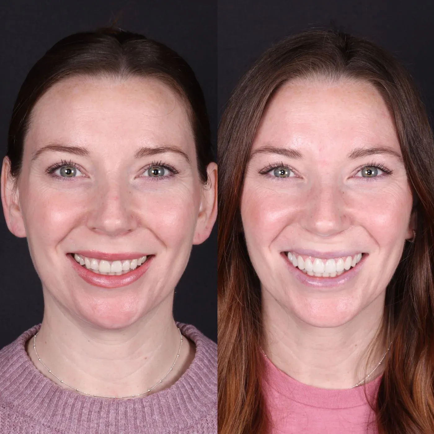 Before and after smile transformation by Dr. Kooper