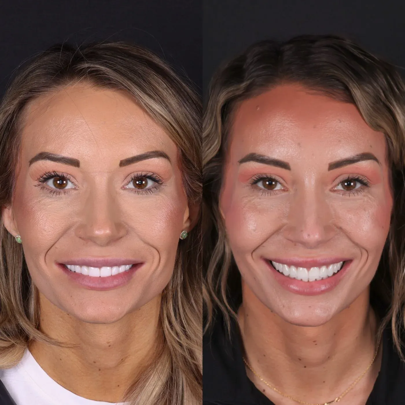 Before and after smile transformation by Dr. Kooper