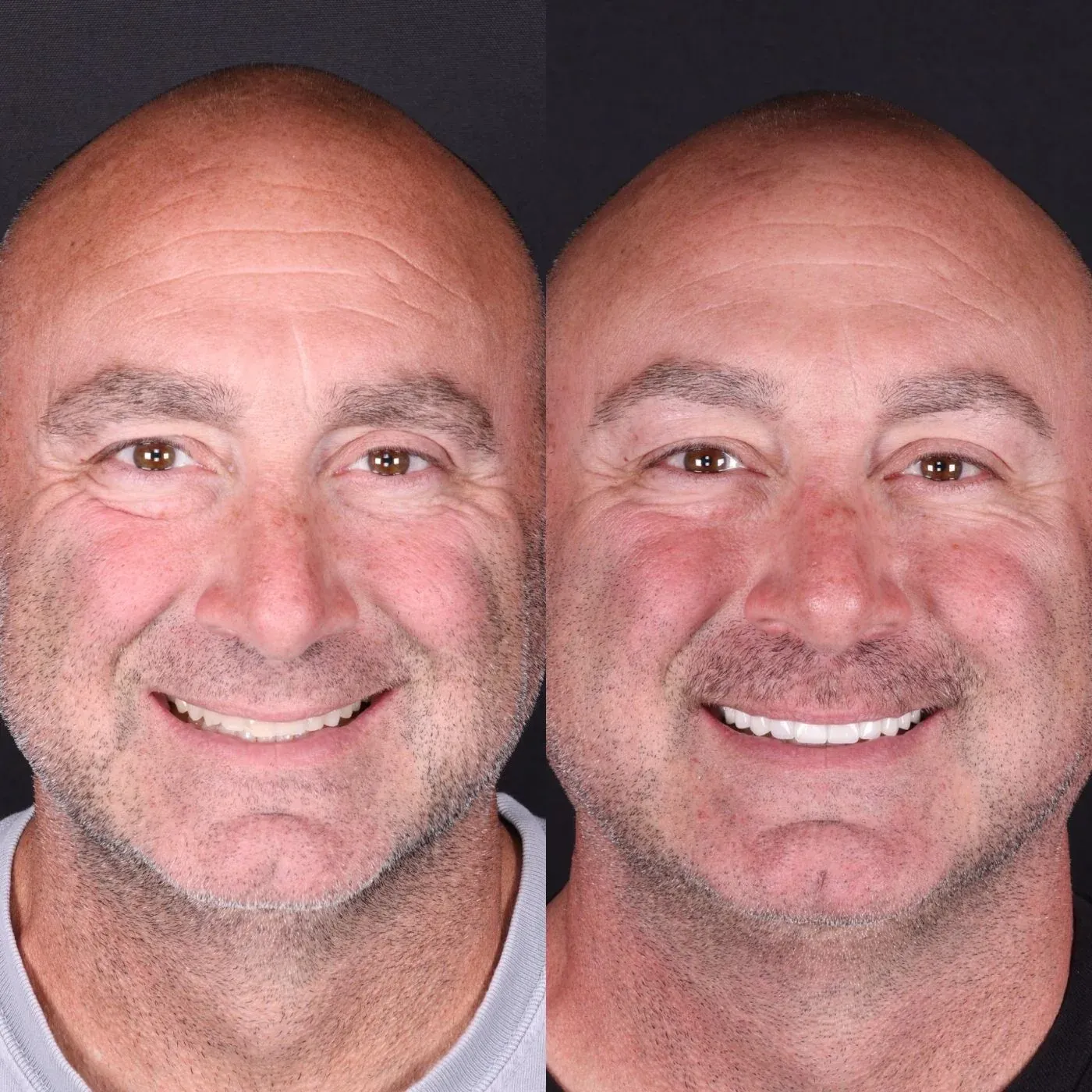 Before and after smile transformation by Dr. Kooper