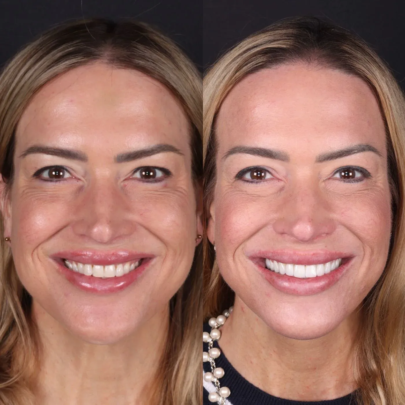 Before and after smile transformation by Dr. Kooper