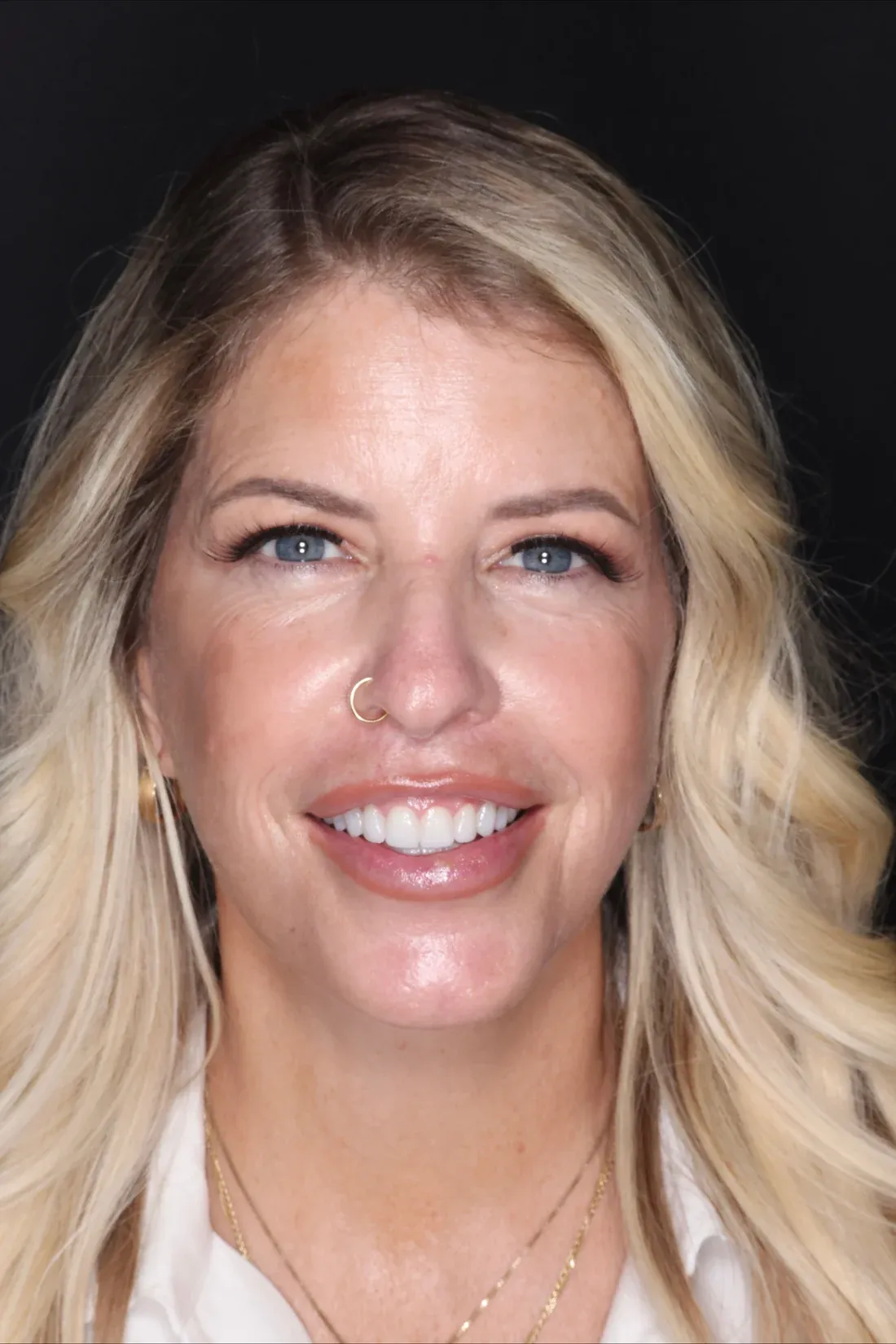 405 Dental Aesthetics patient smiling after her smile makeover with Dr. Kooper